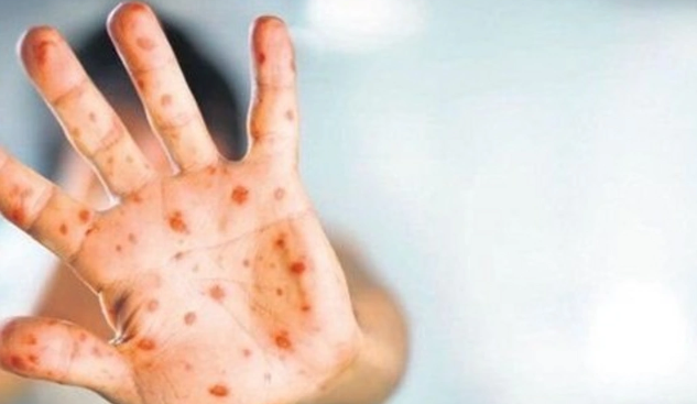 Nə suçiçəyidir, nə də koronavirus: Dünyada sürətlə yayılan meymunçiçəyinə kimlər yoluxa bilərlər? - ARAŞDIRMA