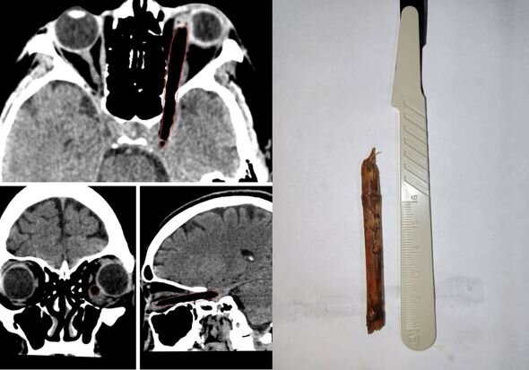 Həkimlər qadının gözündən səkkiz santimetrlik budaq parçası çıxarıblar - FOTO