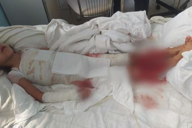 Bədəni yanan Yağmur yardıma möhtacdır: Sizdən kömək gözləyir - FOTO