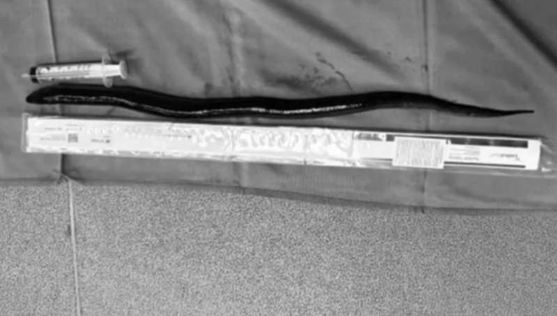 Kişinin mədəsindən 30 santimetrlik diri ilan balığı çıxarılıb