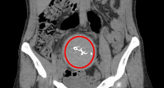 DƏHŞƏT:2 il əvvəl doğan qadın keçməyən ağrılara görə xəstəxanaya getdi, həyatının şokunu yaşadı