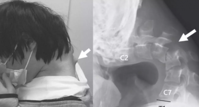 Əyilən baş sindromu nədir və necə qurtulmaq olar? - Həkim danışdı