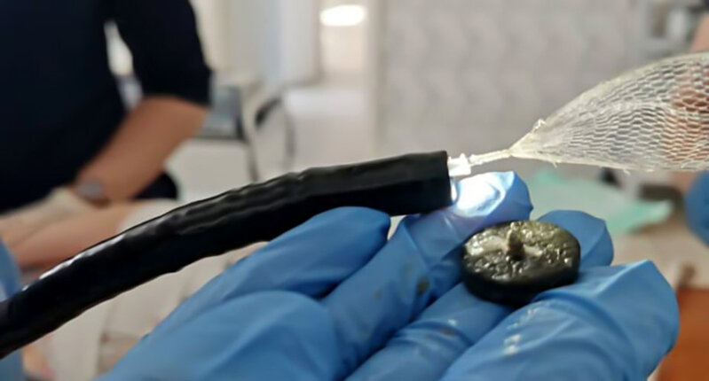 Həkimlər beş yaşlı qızın mədəsindən maqnit çıxartdılar