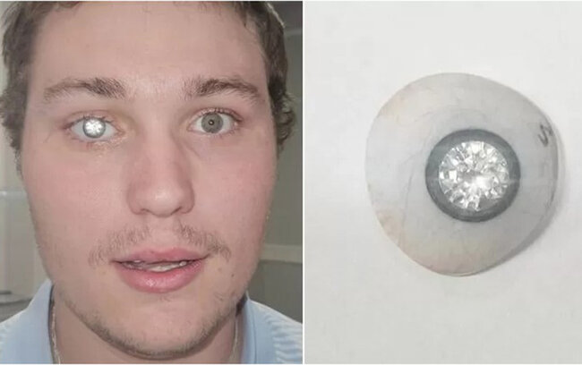 Dünyaya artıq brilyant göz protezi ilə baxır...