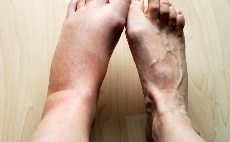 Ayaqlarınız sağlamlığınız haqqında nə deyir? Şişkinlik, uyuşma, iynəbatma hissi...