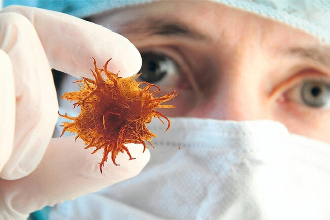 Dünyada xərçəng niyə sürətlə cavanlaşır? - Alimlər XƏBƏRDARLIQ EDİR