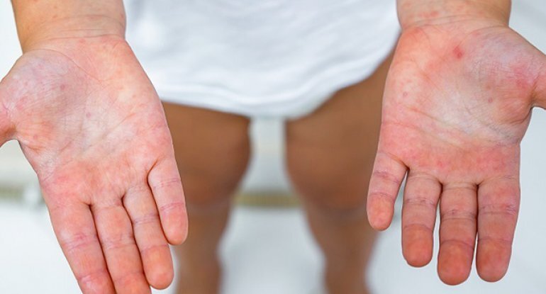 Bu xəstəlik qızılca ilə səhv salınır