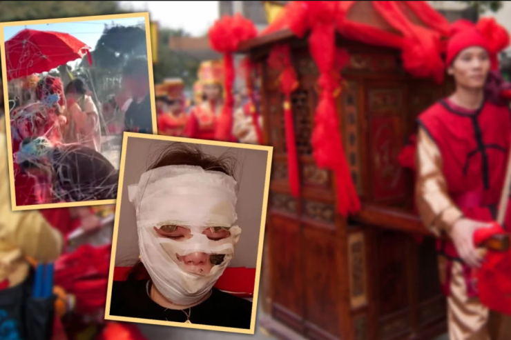 Qonaqlar toyda gəlinin üzünü yandırdılar - FOTO