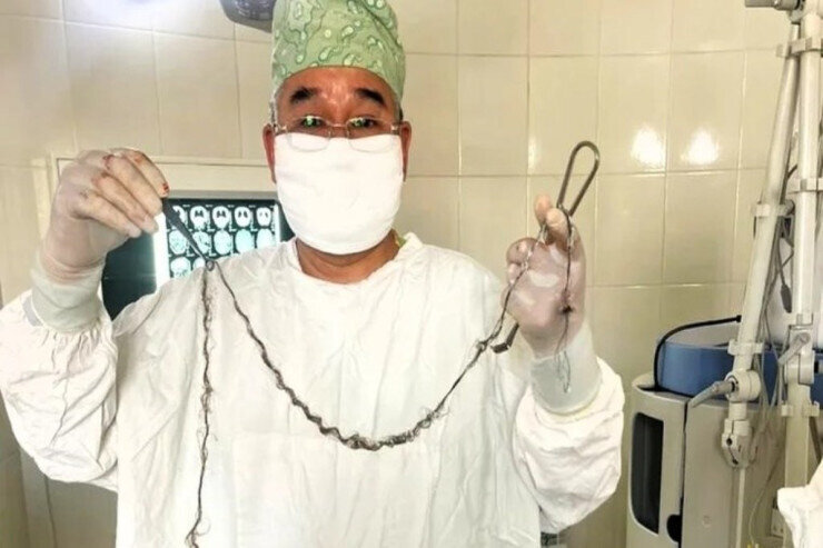 8 yaşlı qızın beynindən bir metr tük çıxarıldı