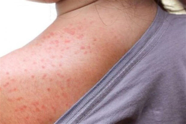 Hacıqabulda 17 yaşlı qız qızılcadan ölüb