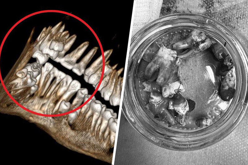 Məktəblinin 14 əlavə dişi varmış - Həkimlər ŞOKDA