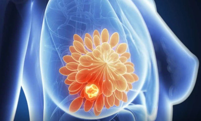 Döş xərçənginin müalicəsində inqilab: Bu dərmanı yadda saxlayın