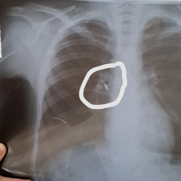 Azərbaycanda həkim yad cisim udan uşağa soyuqlama əleyhinə müalicə yazdı