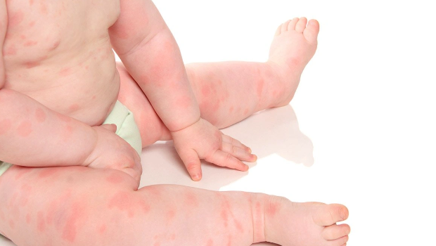 Son zamanlar uşaqlarda allergiyanın həddindən artıq artmasının səbəbi nədir?