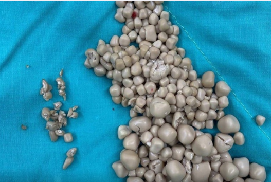 Qadının böyrəyində 300-dən çox daş tapıldı