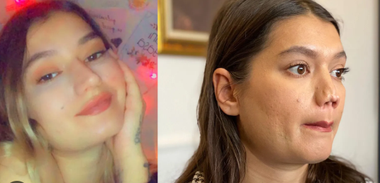 Plastik əməliyyat toyu ləğv etdi: Gəlin həkimdən 1 milyon təzminat istəyir