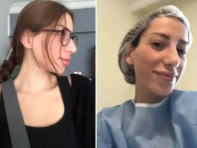 Dövlət xəstəxanasında burnunu əməliyyat etdirdi, "dəyişimi" ilə təəccübləndirdi - VİDEO