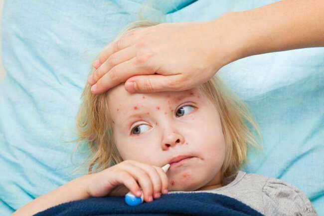 Uşaqların qızılcaya yoluxması ilə bağlı VACİB AÇIQLAMA - VİDEO