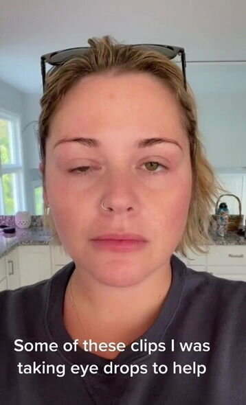 Botoks elətdirən qadının üzü iflic oldu - FOTO - VİDEO