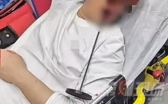 İçki içdi, dəhşət yaşadı - Metal çubuq beyninə qədər irəlilədi - FOTO