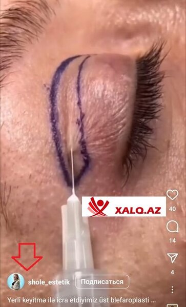 Şölə Məmişova "Aristokrat"da estetik prosedurları icra edir?