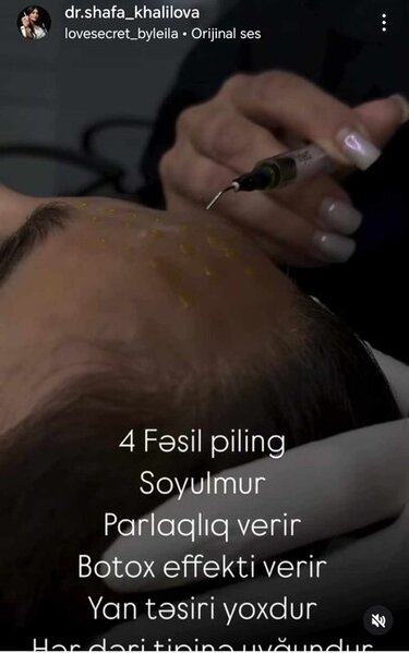 Şəfa Xəlilova dolğu,inyeksiya, botox prosedurlarını necə icra edir? -Fotofaktlar