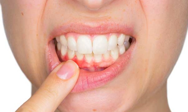 Diş ağardılması və müalicəsində edilən səhvlər