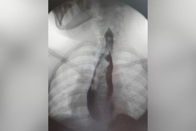 İki mədəsi olan qız əməliyyat olundu