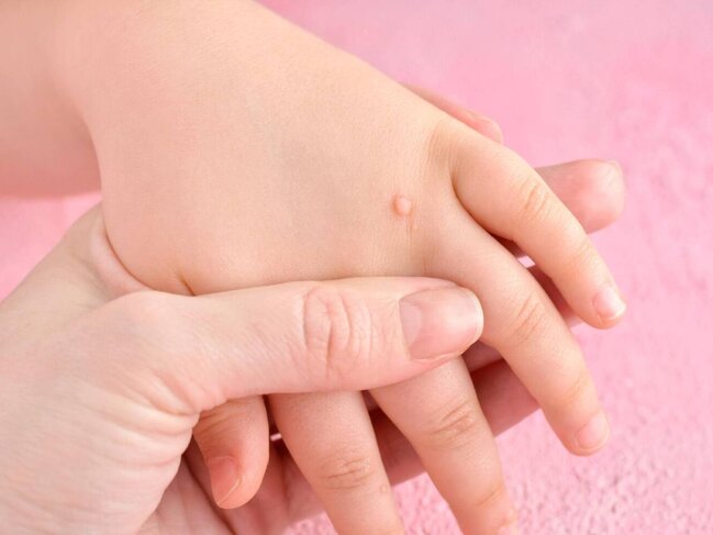 Sarımsaq əzməsini ziyilin üstünə vurun - Yox edəcək