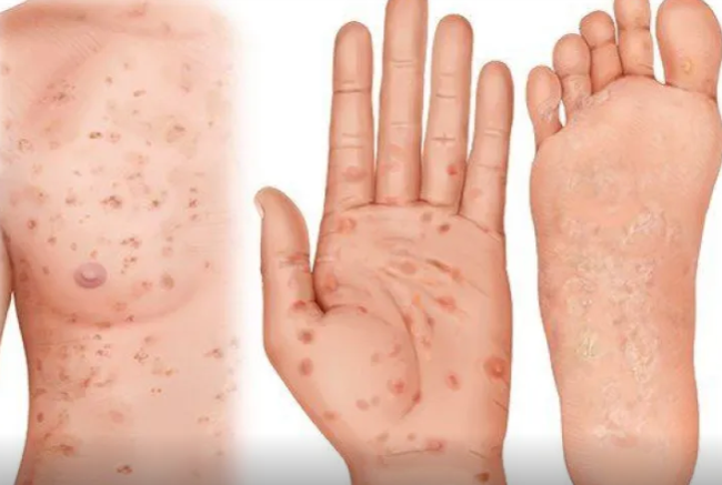 Sifilis geri döndü: Keçən əsrdən qalma infeksiya niyə yenidən güclənir?