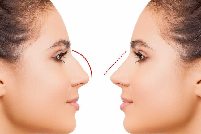 Azərbaycanda bu şəxslərə burun əməliyyatı pulsuz OLDU