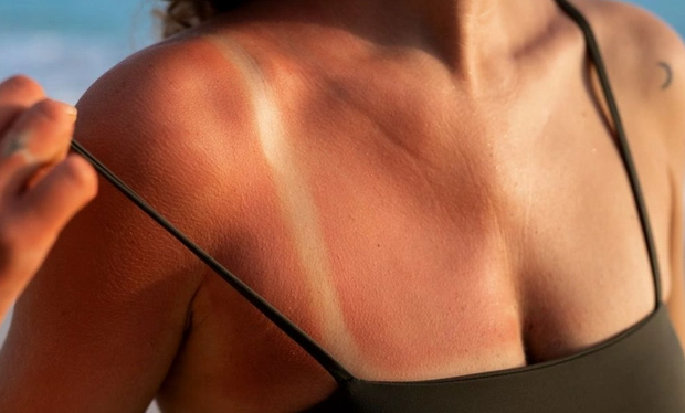 Həkimlərdən XƏBƏRDARLIQ: Bəzi ağartı məhsulları günəş yanıqlarını daha da ağırlaşdırır