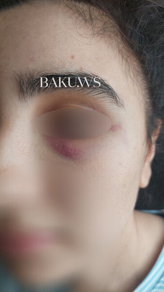 Bakı məktəbində sinif yoldaşları məktəbli qızı vəhşicəsinə döydülər - FOTO/VİDEO