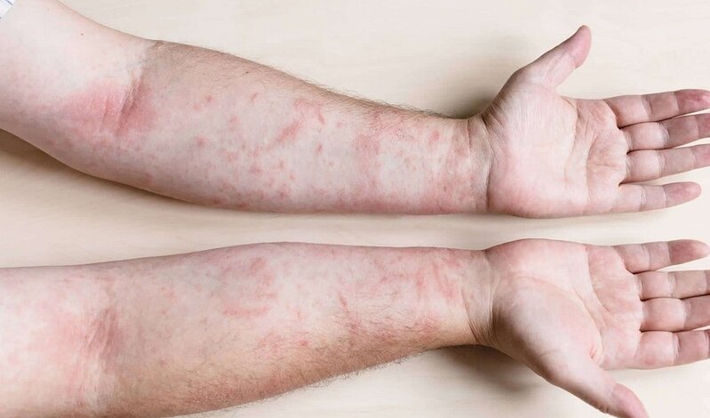 "Rayonlarda qızılcanın artma səbəbi..." - İnfeksionist AÇIQLADI