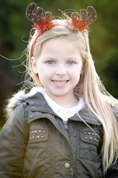 Bu qız "təlxək burnu" ilə doğulub - İllər sonrakı HALI - FOTO