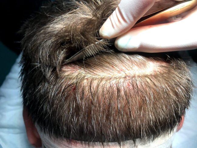 47 yaşlı kişi saç əkimi zamanı öldü