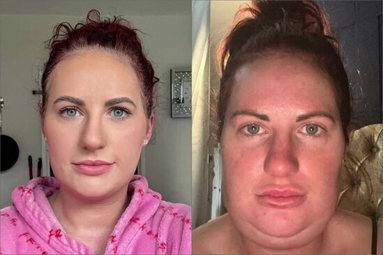 Buxağını kiçiltmək istədi, üzü dörd dəfə böyüdü - FOTO/VİDEO