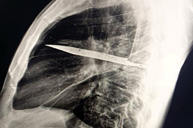 8 il sinəsində bıçaqla yaşayıb: bundan xəbəri olmayıb