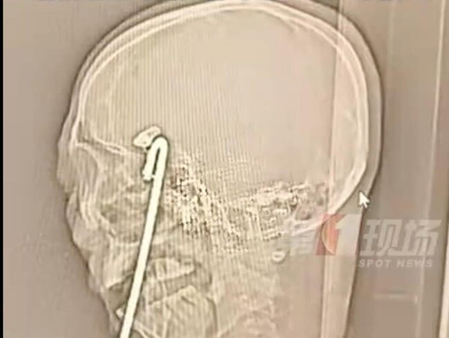 İçki içdi, dəhşət yaşadı - Metal çubuq beyninə qədər irəlilədi - FOTO