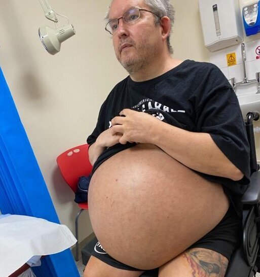 Bu kişi hamilə deyil, sadəcə böyrəkləri 35 kiloqramdır - FOTO