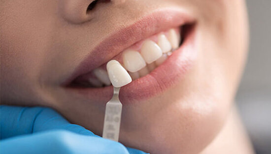 Zirkon qapaq yoxsa metal keramikaya üstünlük verək?