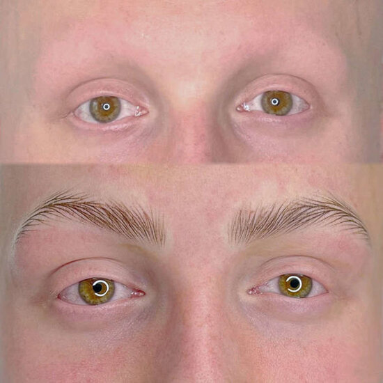 İmtahanlara görə həyəcanlanan yeniyetmə tamamilə keçəlləşdi - FOTO