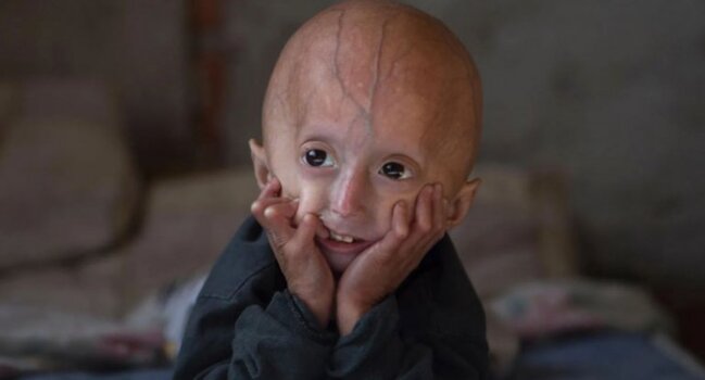 Uşaqlar sürətlə qocalır, ömrü qısalır - Progeriya xəstəliyi nədir?