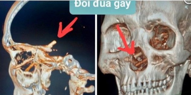 Aylardır başı ağrıyan kişinin beynində görün nə tapıldı - Həkimlər heyrətə gəldi