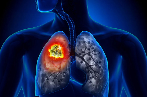 Ağciyər xərçənginin müalicəsində yeni ümid: Alimlər xəstəliyin "zəif nöqtəsini" tapdılar