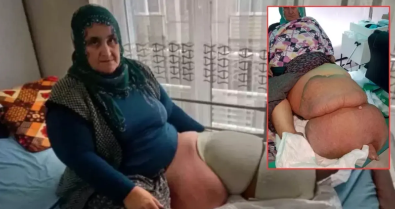 35 ildir eyni xəstəliklə mübarizə aparır! Ayağının ağırlığı 100 kiloya qalxıb - VİDEO