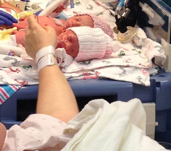 Doğulanda əl-ələ tutan əkizlər indi də ayrılmırlar - FOTOLAR