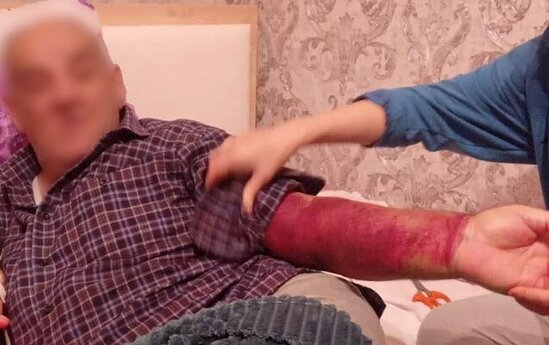 "Medical Plaza"da 4500 AZN alıb qan köçürdülər, qolu bu vəziyyətə düşdü"