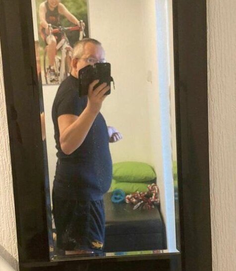 Bu kişi hamilə deyil, sadəcə böyrəkləri 35 kiloqramdır - FOTO