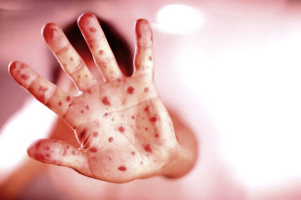 Cəlilabadda son on gündə qızılcaya yoluxanların sayı AÇIQLANDI